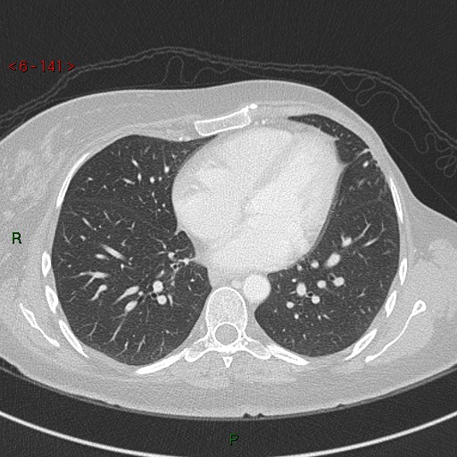 Aortic arch origin of left vertebral artery (Radiopaedia 51520-57286 Axial lung window 141).jpg