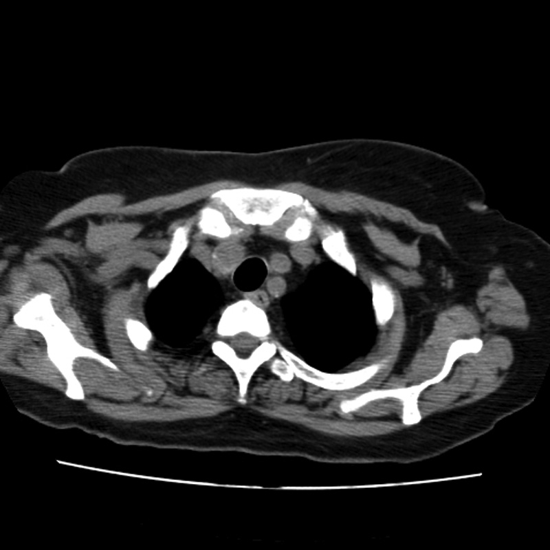 Aortic arch pseudoaneurysm (Radiopaedia 8534-9368 Axial non-contrast 6).jpg