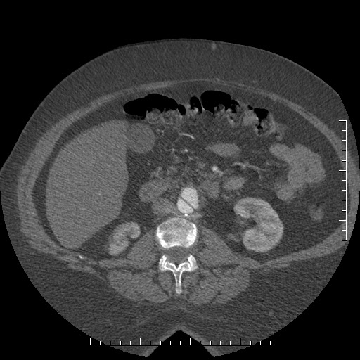 File:Aortic dissection- Stanford A (Radiopaedia 35729-37268 C 5).jpg