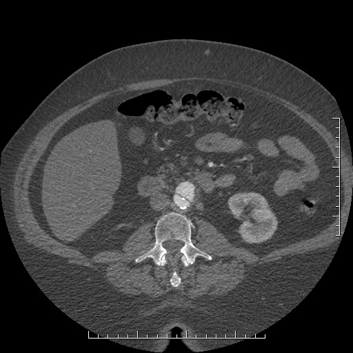 File:Aortic dissection- Stanford A (Radiopaedia 35729-37268 C 9).jpg