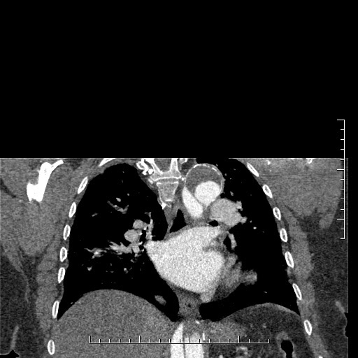File:Aortic dissection- Stanford A (Radiopaedia 35729-37268 E 17).jpg