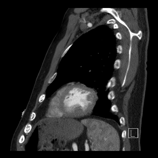 File:Aortic dissection (CTPA) (Radiopaedia 75506-86750 C 84).jpg