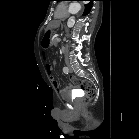Aortic dissection (CTPA) (Radiopaedia 75506-86750 G 54).jpg