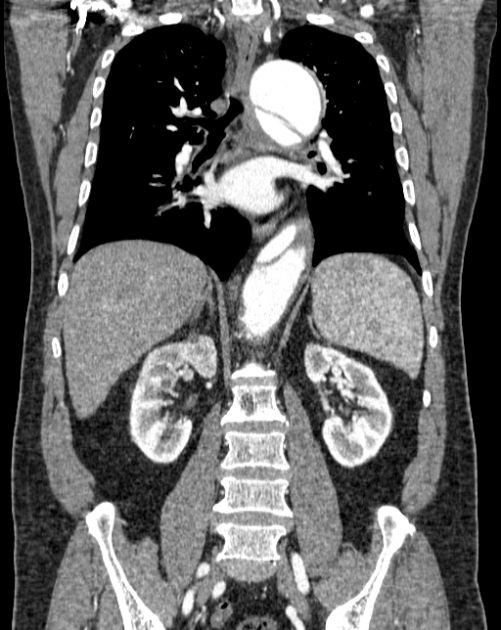 Aortic dissection (Radiopaedia 44411-48061 A 36).jpg