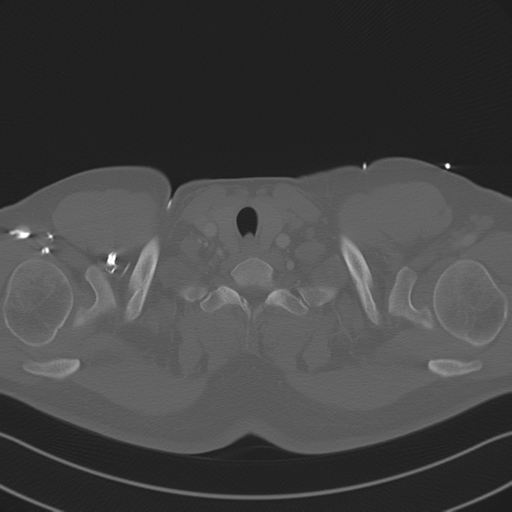 File:Aortic dissection (Radiopaedia 50763-56234 Axial bone window 9).png