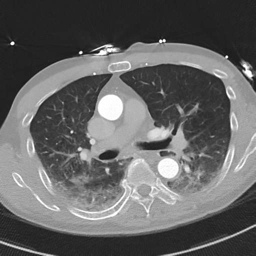 File:Aortic dissection - DeBakey type II (Radiopaedia 64302-73082 Axial lung window 27).png