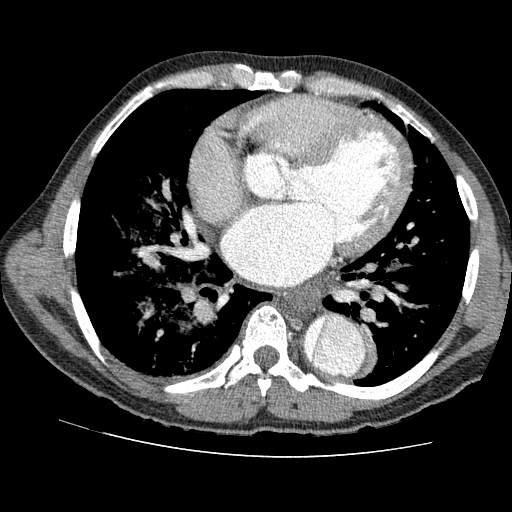 File:Aortic dissection - Stanford A -DeBakey I (Radiopaedia 28339-28587 B 57).jpg