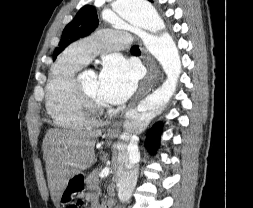 Aortic dissection - Stanford A -DeBakey I (Radiopaedia 28339-28587 C 43).jpg