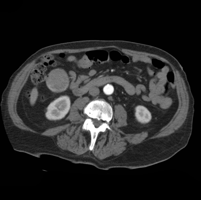 Aortic dissection with rupture into pericardium (Radiopaedia 12384-12647 A 66).jpg