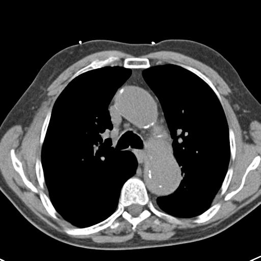 Aortic intramural hematoma (Radiopaedia 31139-31838 Axial non-contrast 21).jpg