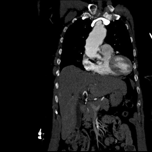 Aortic intramural hematoma from penetrating atherosclerotic ulcer (Radiopaedia 31137-31836 C 19).jpg