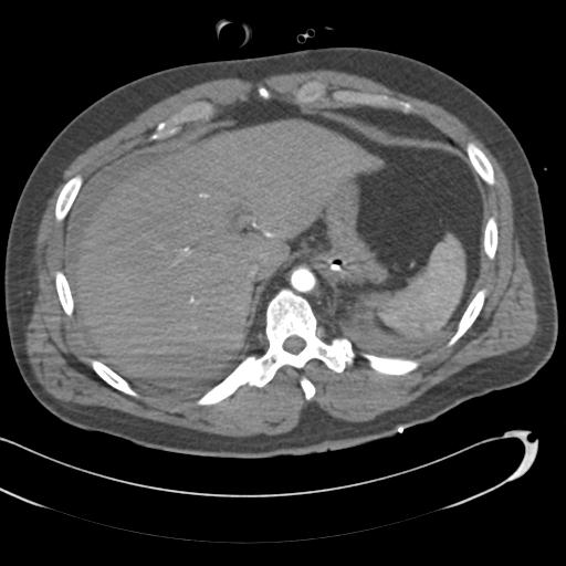 Aortic transection, diaphragmatic rupture and hemoperitoneum in a complex multitrauma patient (Radiopaedia 31701-32622 A 78).jpg