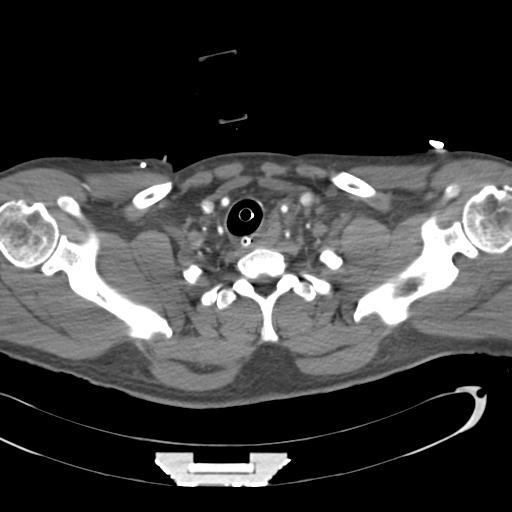 Aortic transection, diaphragmatic rupture and hemoperitoneum in a complex multitrauma patient (Radiopaedia 31701-32622 A 9).jpg