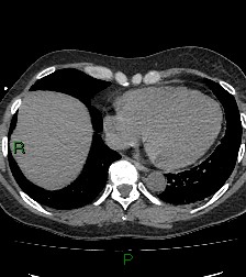 Aortic valve endocarditis (Radiopaedia 87209-103485 Axial non-contrast 73).jpg