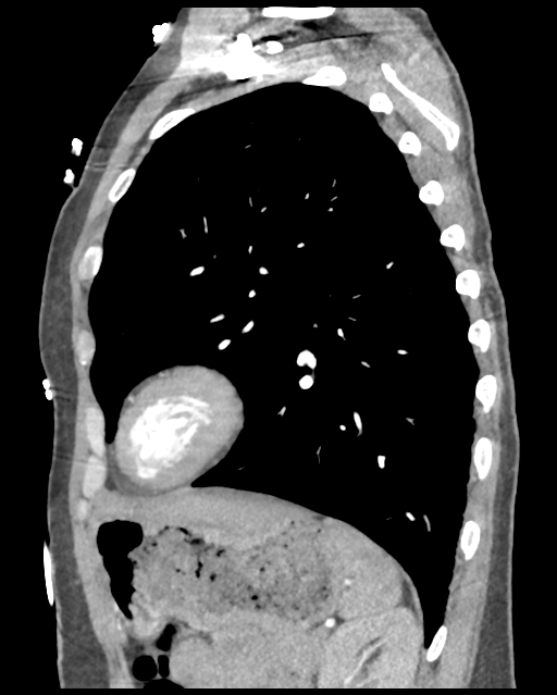 Aortic valve non-coronary cusp thrombus (Radiopaedia 55661-62189 D 16).png