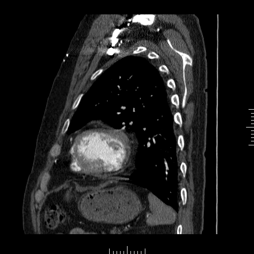 File:Aorto-coronary bypass graft aneurysms (Radiopaedia 40562-43157 C 34).png
