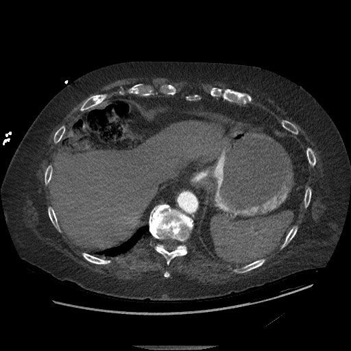 Aortoesophageal fistula with endovascular repair (Radiopaedia 73781-84592 Axial C+ CTPA 149).jpg