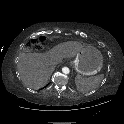 File:Aortoesophageal fistula with endovascular repair (Radiopaedia 73781-84592 Axial C+ CTPA 153).jpg