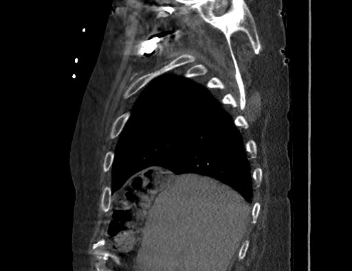 File:Aortoesophageal fistula with endovascular repair (Radiopaedia 73781-84592 Sagittal C+ CTPA 27).jpg