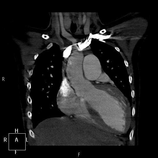 File:Aortopulmonary septal defect (Radiopaedia 41990-45013 Coronal C+ CTPA 17).jpg