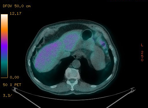 Appendiceal adenocarcinoma complicated by retroperitoneal abscess (Radiopaedia 58007-65041 Axial PET-CT 101).jpg