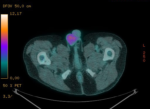 File:Appendiceal adenocarcinoma complicated by retroperitoneal abscess (Radiopaedia 58007-65041 Axial PET-CT 205).jpg