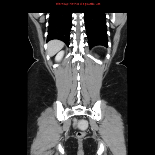 File:Appendiceal mucinous cystadenoma (Radiopaedia 8263-9111 B 60).jpg