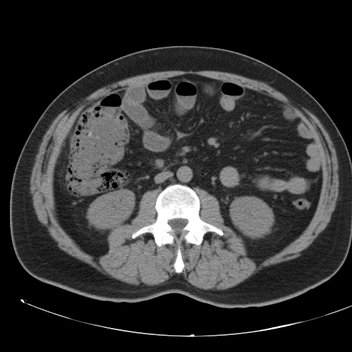 Appendicitis and giant appendicolith (Radiopaedia 80251-93588 Axial non-contrast 27).jpg