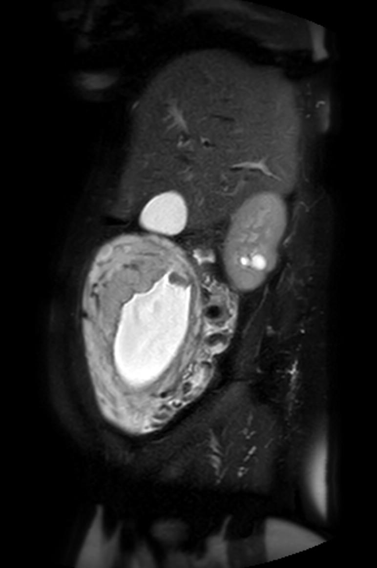 Appendicitis in gravida (MRI) (Radiopaedia 89433-106395 Sagittal T2 SPAIR 48).jpg