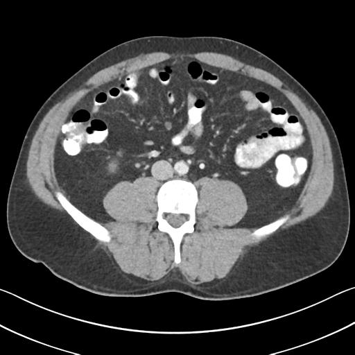 File:Appendicitis with cecal bar sign (Radiopaedia 31878-32830 B 47).jpg