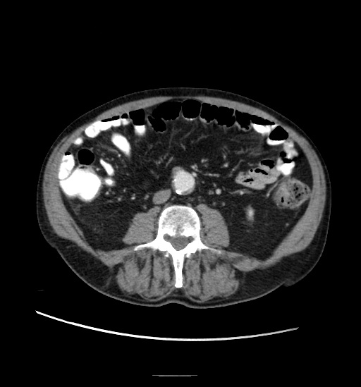 Appendicitis with localized perforation and abscess formation (Radiopaedia 49035-54130 A 51).jpg