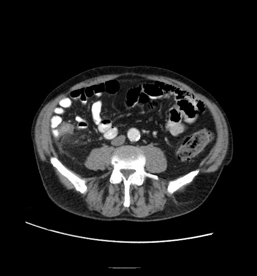 Appendicitis with localized perforation and abscess formation (Radiopaedia 49035-54130 A 55).jpg
