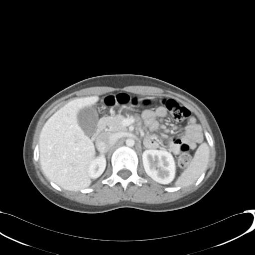 File:Appendicitis with minimal stranding but appendicolith (Radiopaedia 29035-29397 A 27).jpg