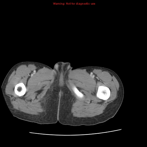 File:Appendicitis with phlegmon (Radiopaedia 9358-10046 A 78).jpg