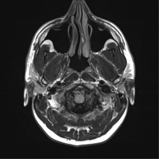 File:Arachnoid cyst - cerebellopontine angle (Radiopaedia 59689-67083 Axial FLAIR 3).png
