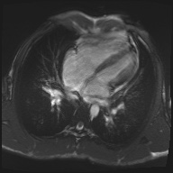 File:Arrhythmogenic right ventricular cardiomyopathy (Radiopaedia 57972-64966 A 9).jpg