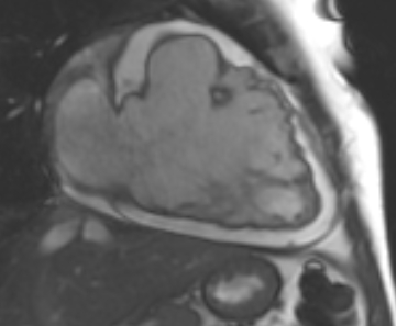 Arrhythmogenic right ventricular cardiomyopathy (Radiopaedia 69431-79307 2ch cine 62).jpg