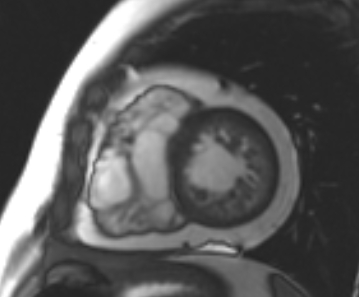 File:Arrhythmogenic right ventricular cardiomyopathy (Radiopaedia 69431-79307 Short axis cine 85).jpg