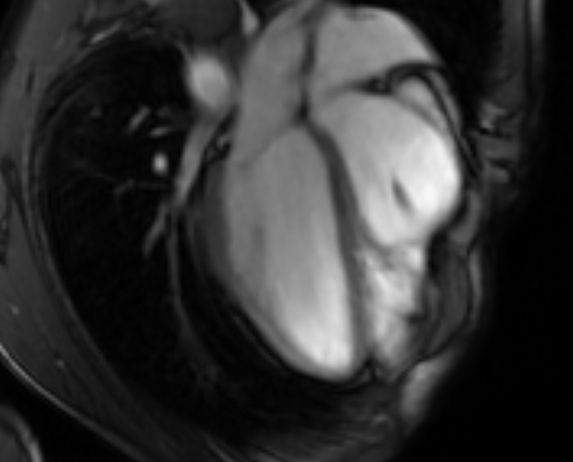 File:Arrhythmogenic right ventricular cardiomyopathy (Radiopaedia 69564-79464 4ch cine 63).jpg