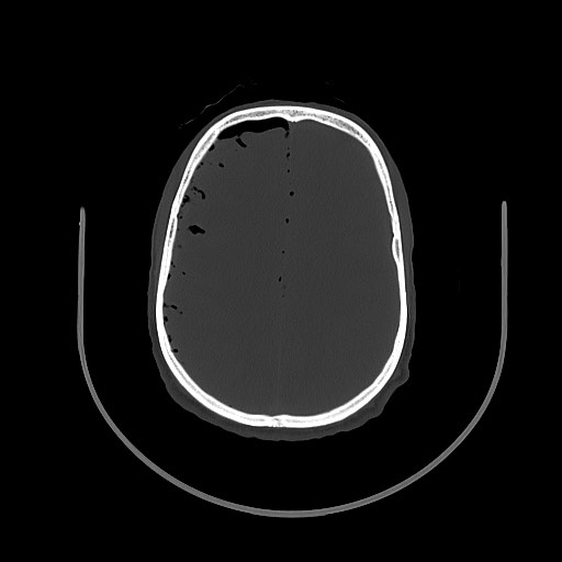 Arrow injury to the brain (Radiopaedia 72101-82607 Axial bone window 79).jpg