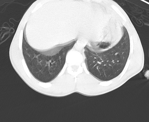 Arrow injury to the chest (Radiopaedia 75223-86321 Axial lung window 80).jpg