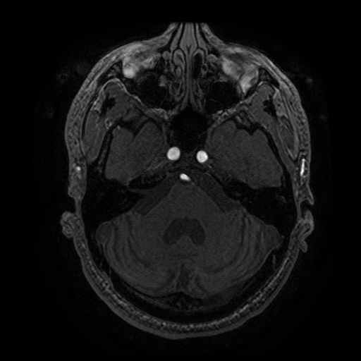 Arteriovenous malformation (Radiopaedia 71628-81999 Axial MRA 76).jpg