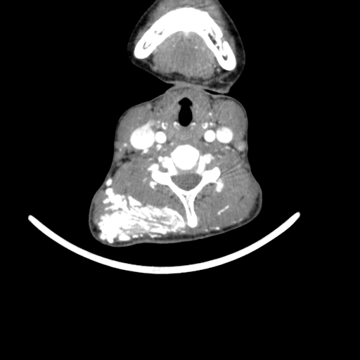 Arteriovenous malformation of the neck (Radiopaedia 53935-60062 A 25).jpg