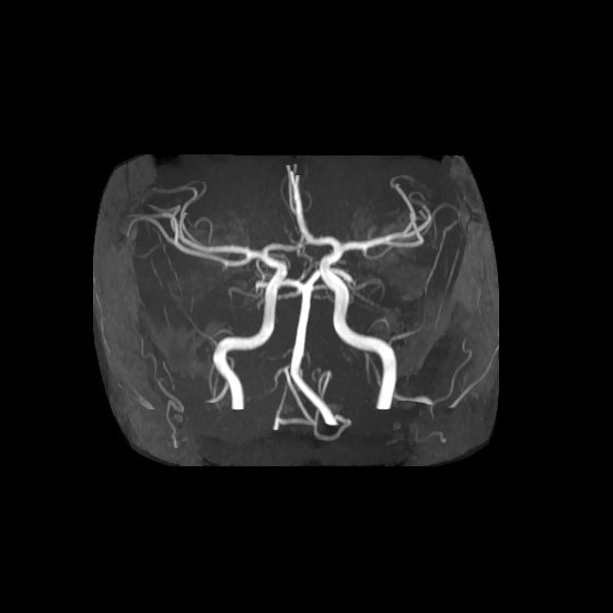 Artery of Percheron infarct (Radiopaedia 40966-43676 F 6).jpg