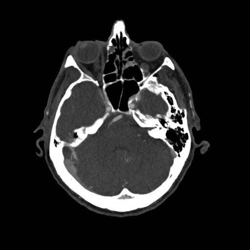 Artery of Percheron infarct (Radiopaedia 48088-52894 A 119).jpg