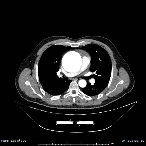 Ascending aortic aneurysm (Radiopaedia 50086-55404 A 33).jpg