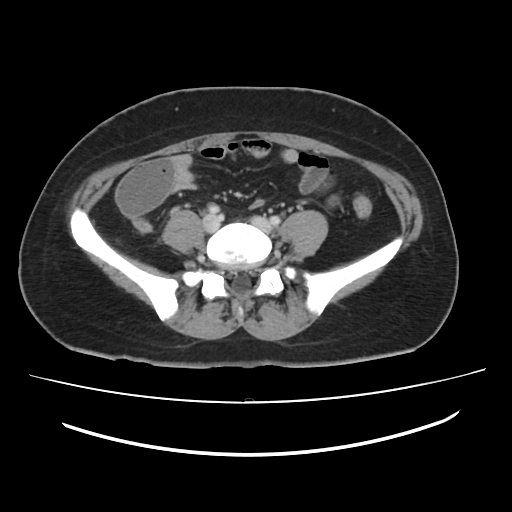 Ascending retrocecal appendicitis with liver abscesses (Radiopaedia 60066-67615 B 62).jpg