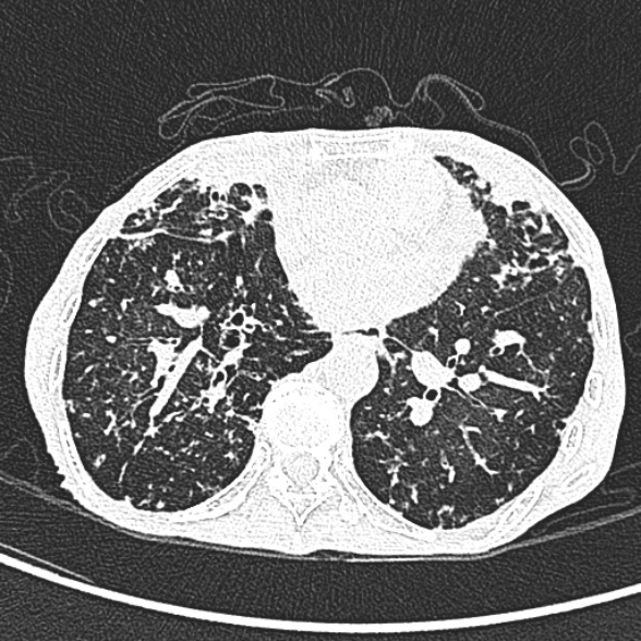 File:Aspergilloma- with Monod sign (Radiopaedia 44737-48532 Axial lung window 172).jpg