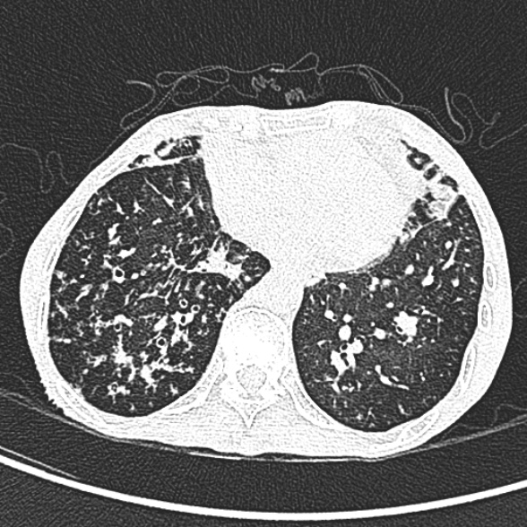 Aspergilloma- with Monod sign (Radiopaedia 44737-48532 Axial lung window 202).jpg