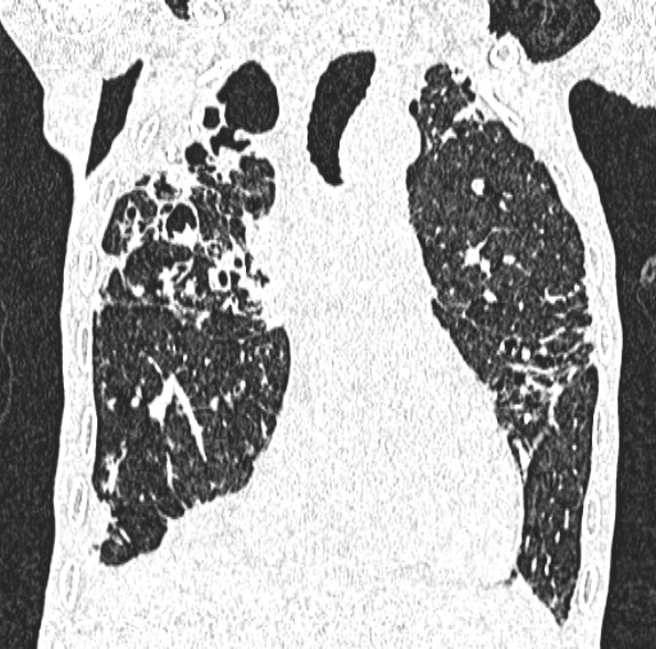 Aspergilloma- with Monod sign (Radiopaedia 44737-48532 Coronal lung window 215).jpg